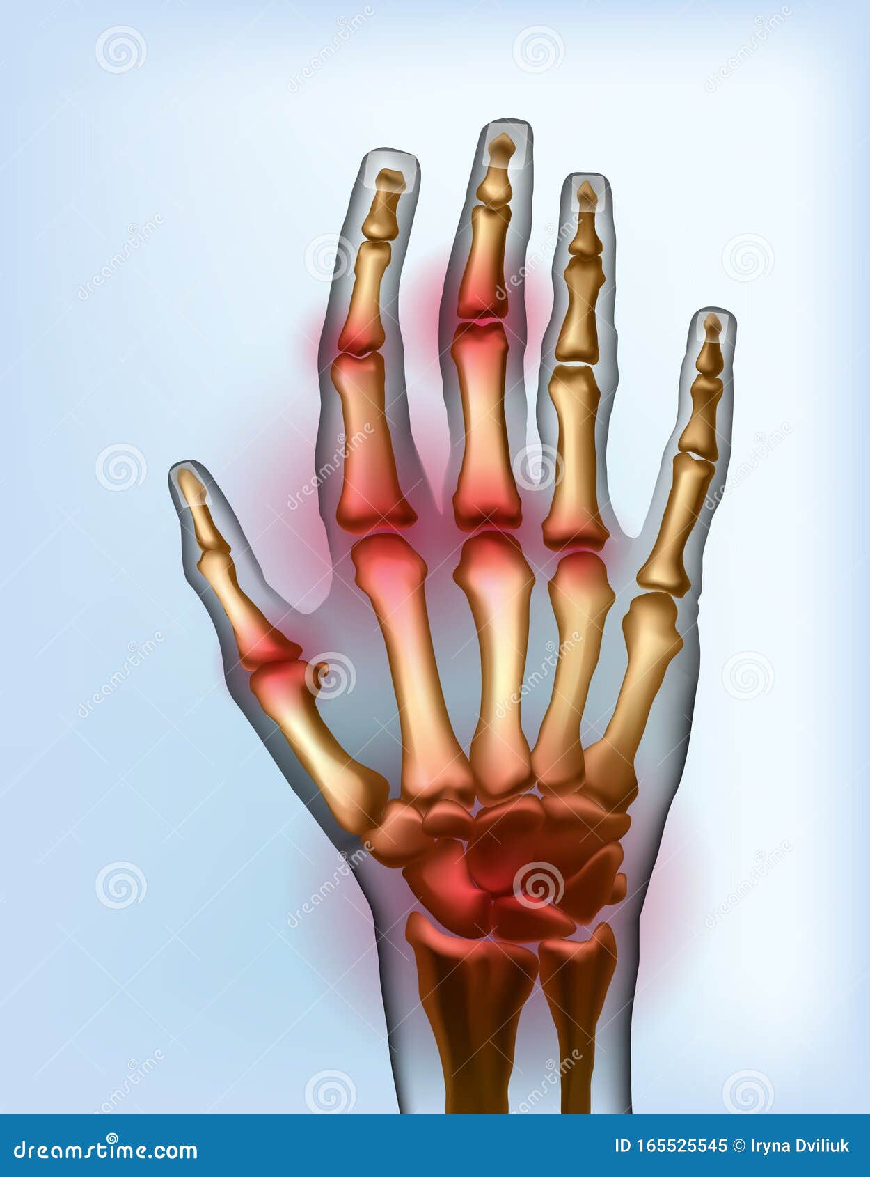 frontal view image sore osteoarthritis joints of bones the of hand.