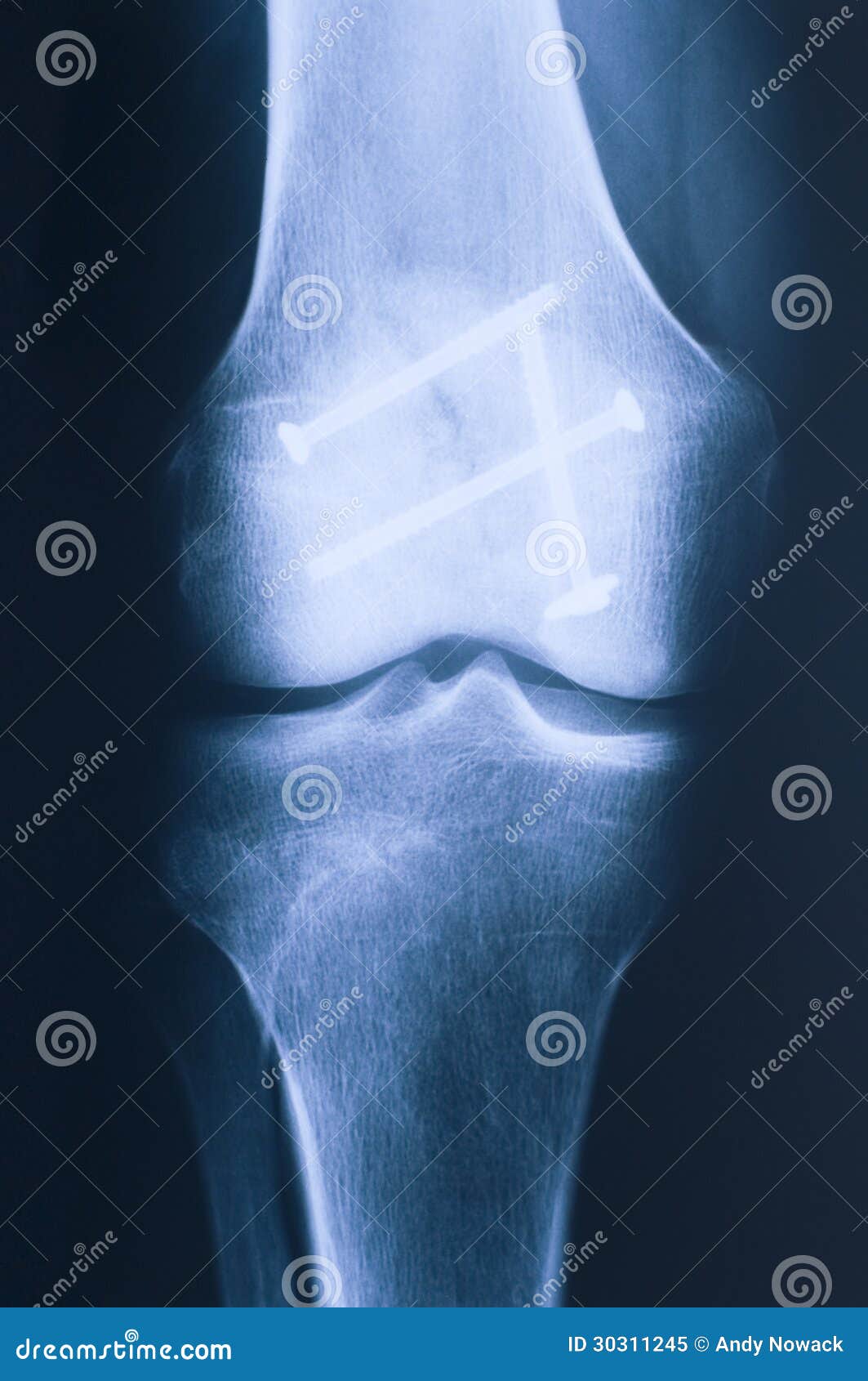 Xray Of Knee Front Royalty Free Stock Photo Image 30311245