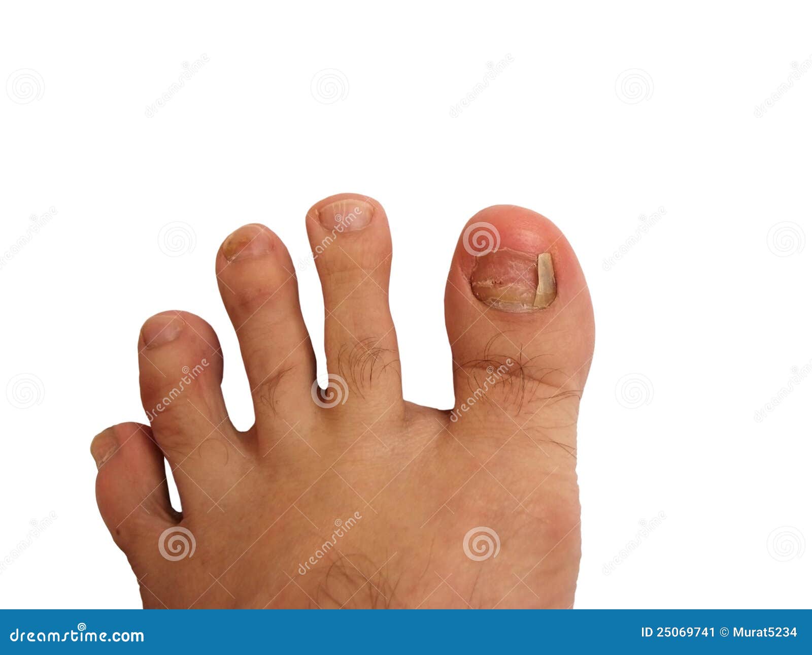 Fuß Ohne ZeheNagel Stockbild Bild 25069741