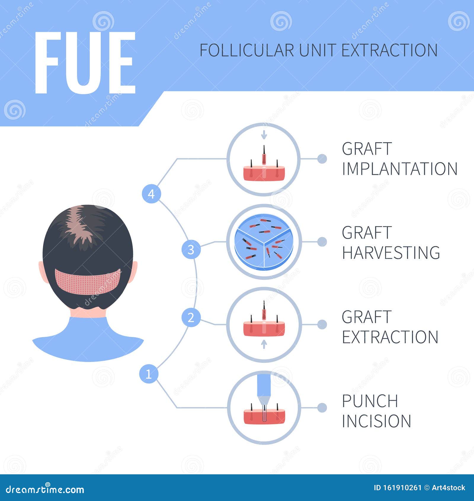 fue hair transplantation medical infographics for women