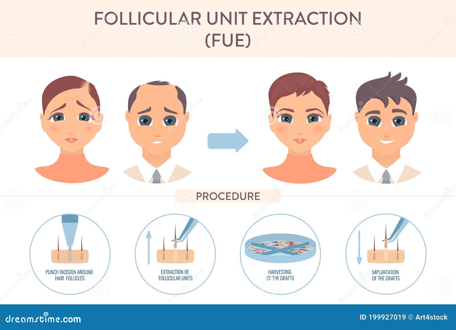 fue hair transplantation procedure medical infographic poster