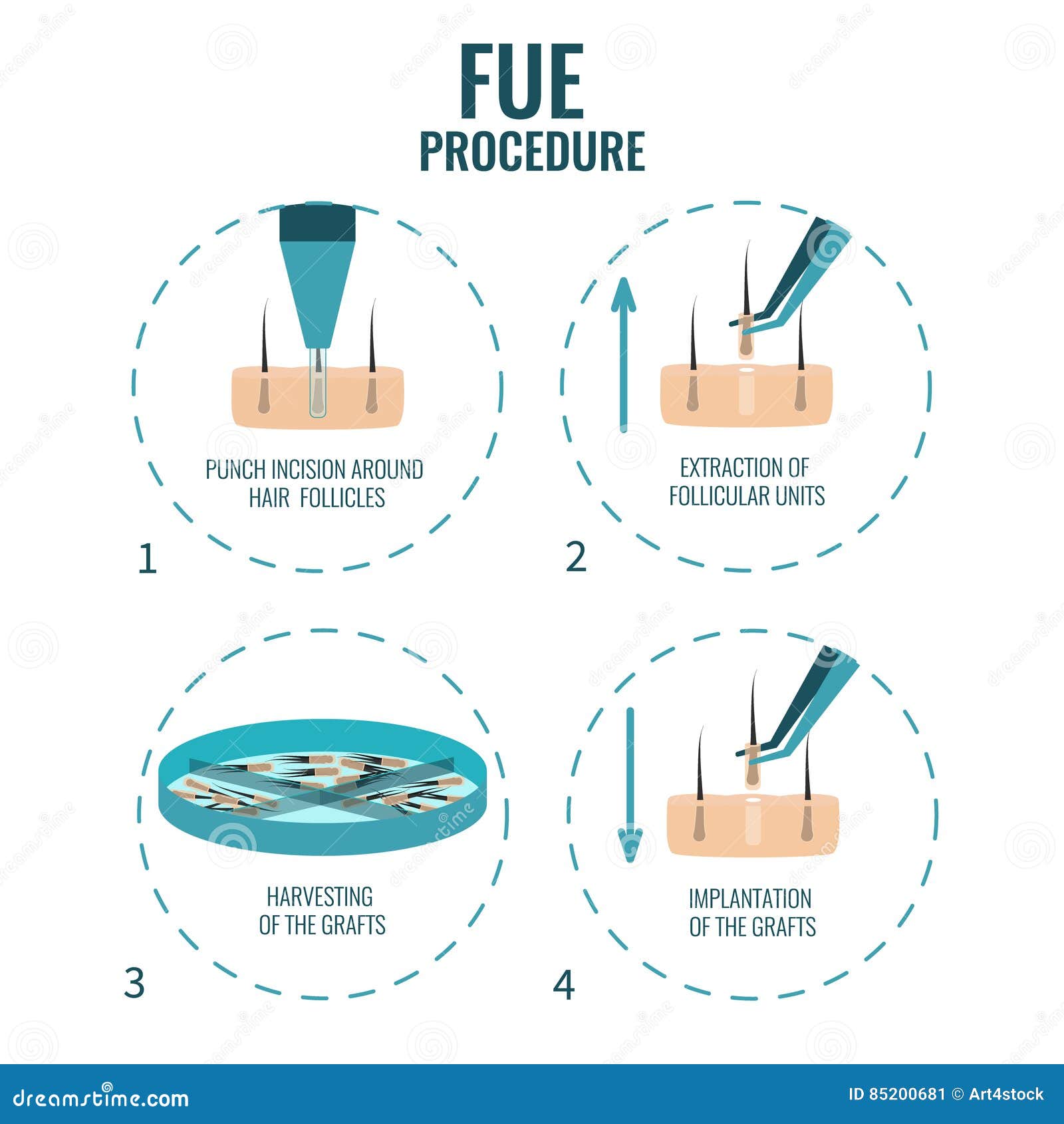 fue stages treatment