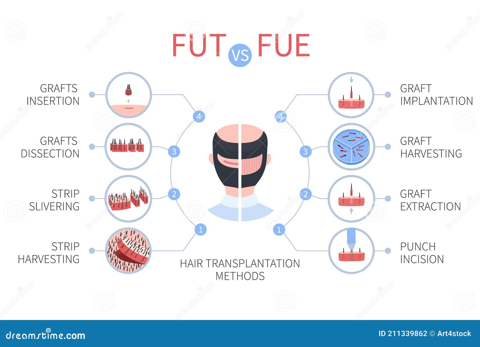 fue vs fut hair transplantation medical infographics