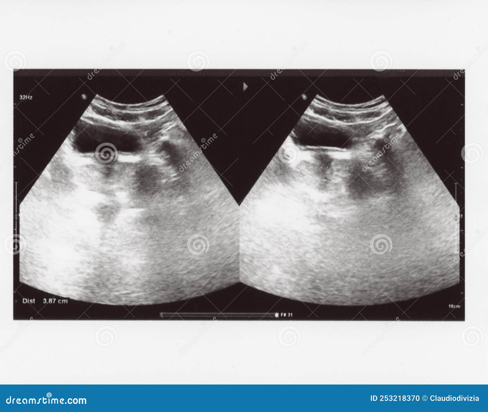 full abdomen ultrasound sonogram