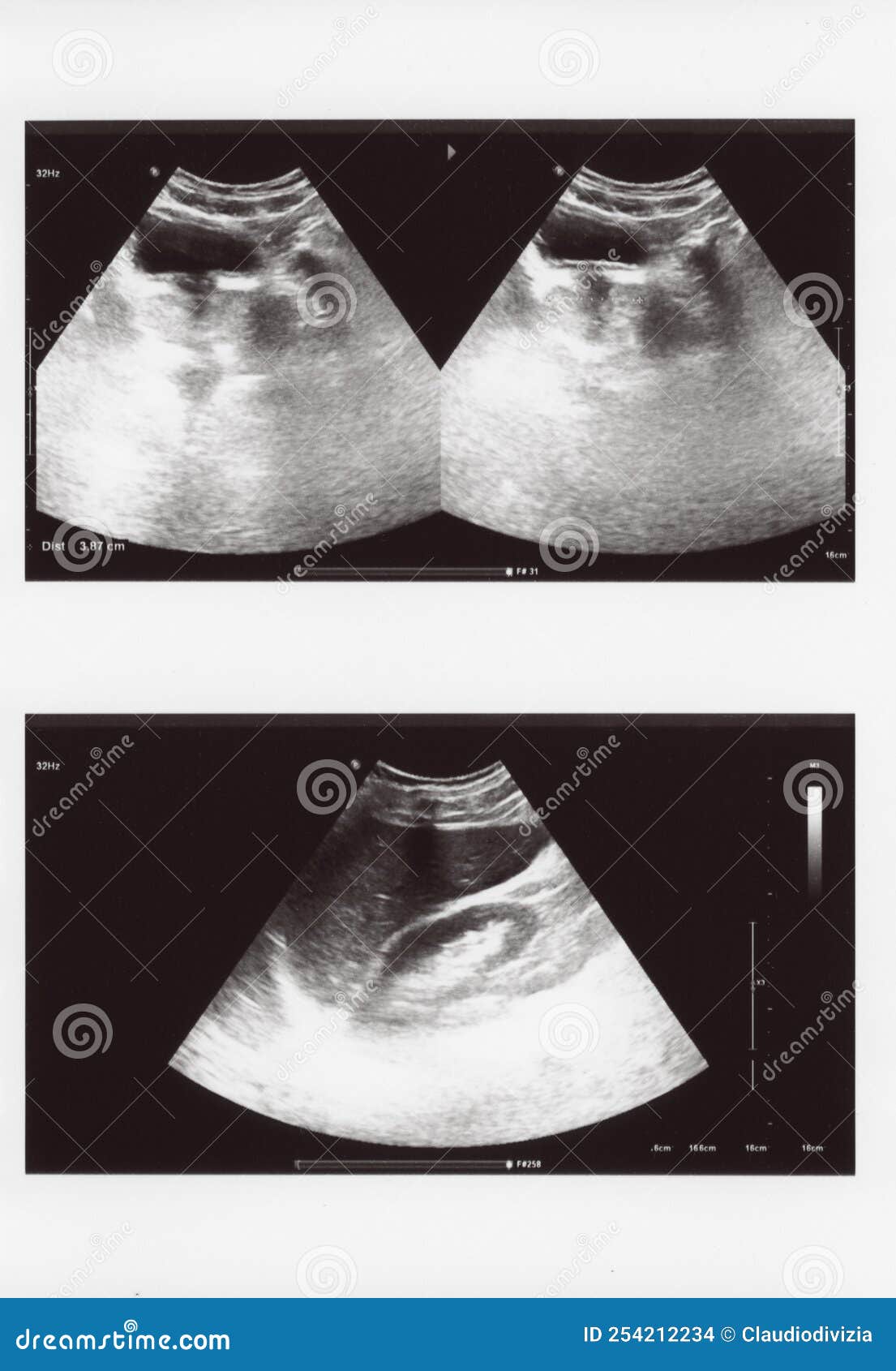 Full Abdomen Ultrasound Sonogram Stock Photo Image of gallbladder