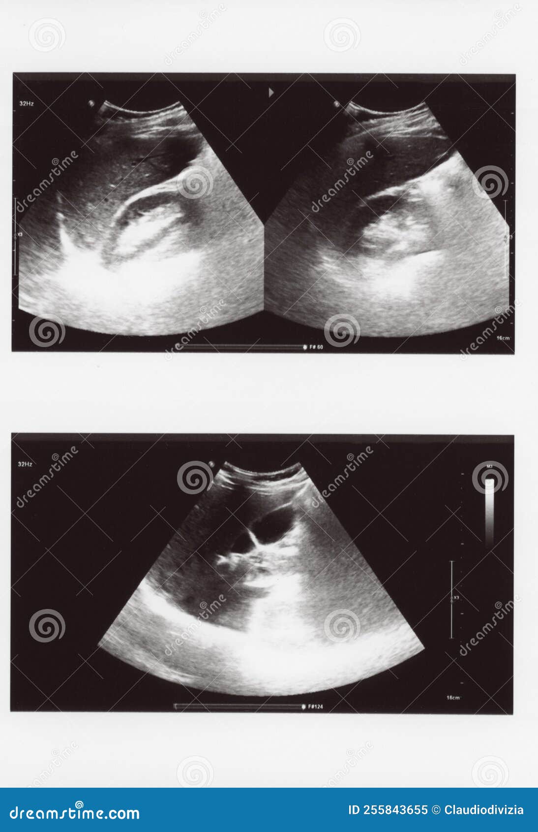 full abdomen ultrasound sonogram