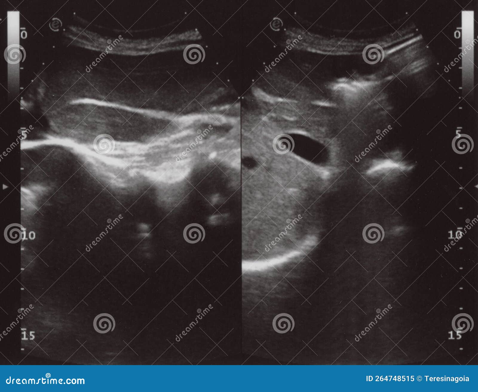 full abdomen ultrasound sonogram