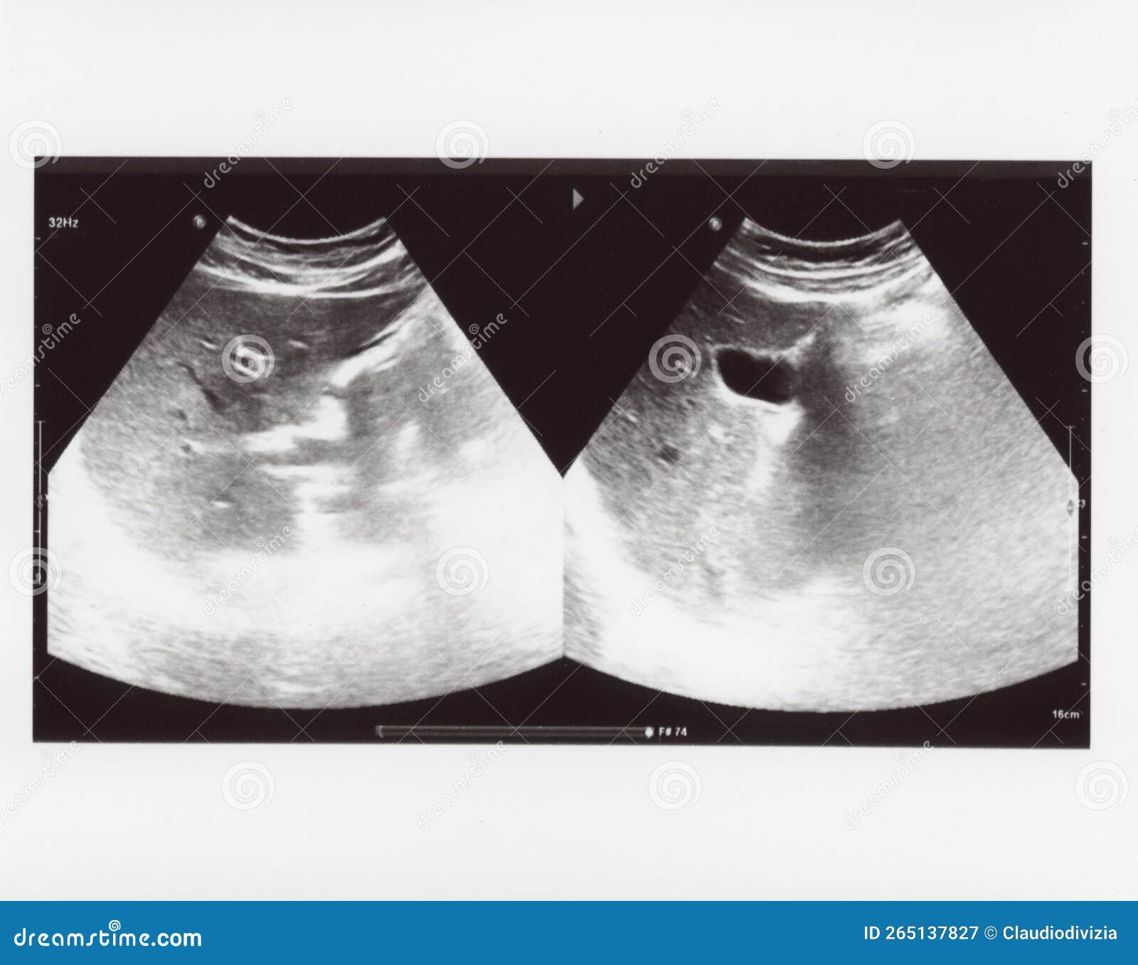 full abdomen ultrasound sonogram