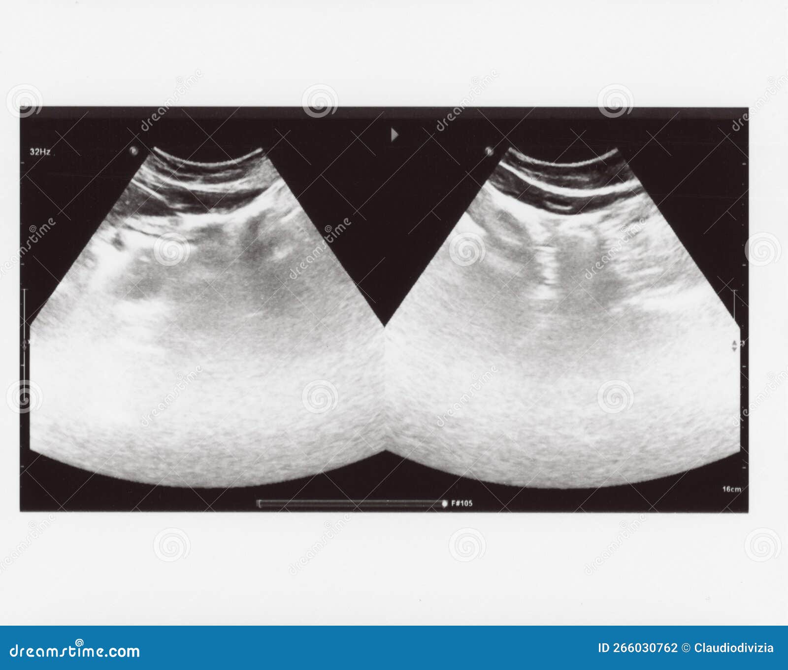 full abdomen ultrasound sonogram