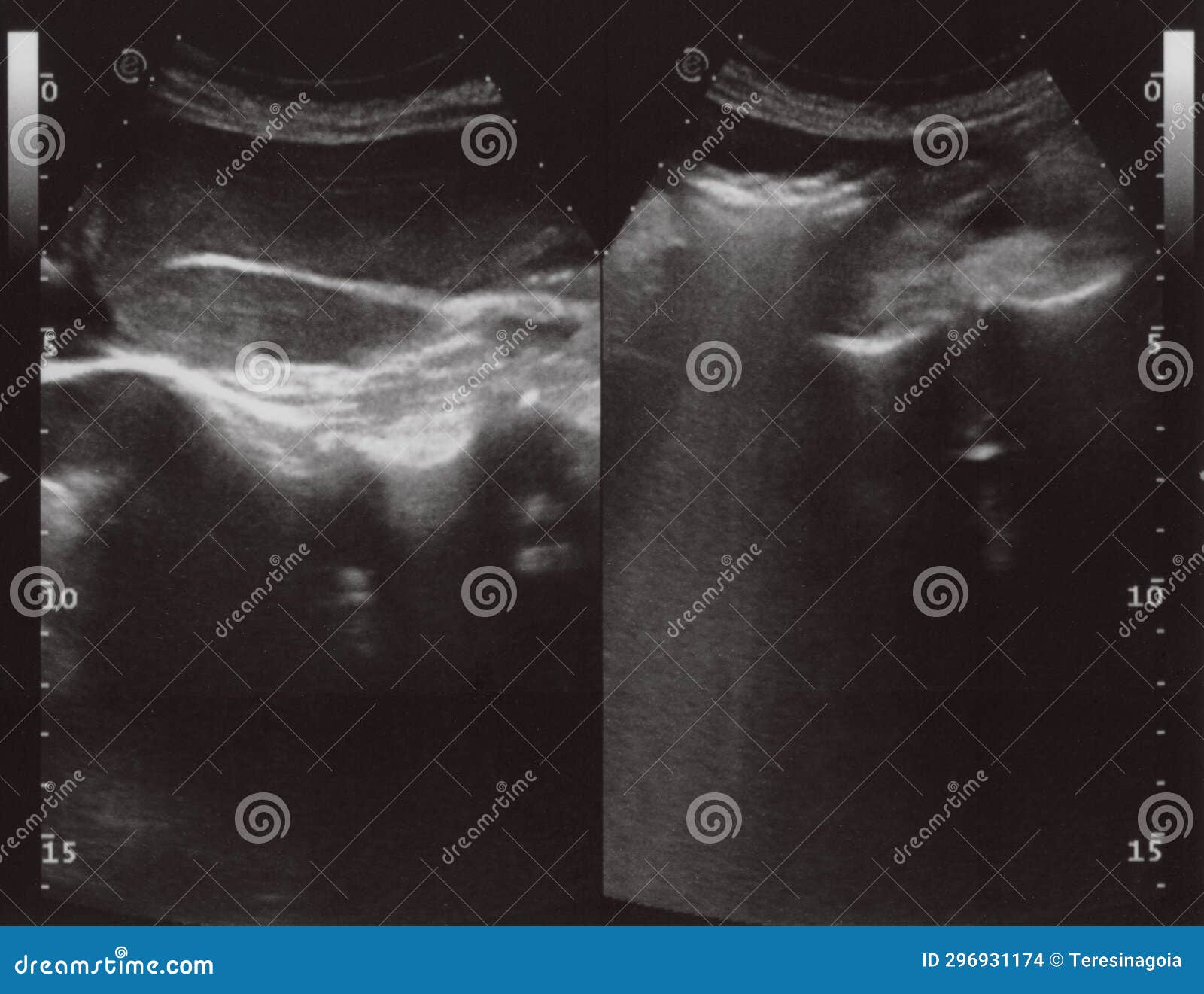 full abdomen ultrasound sonogram