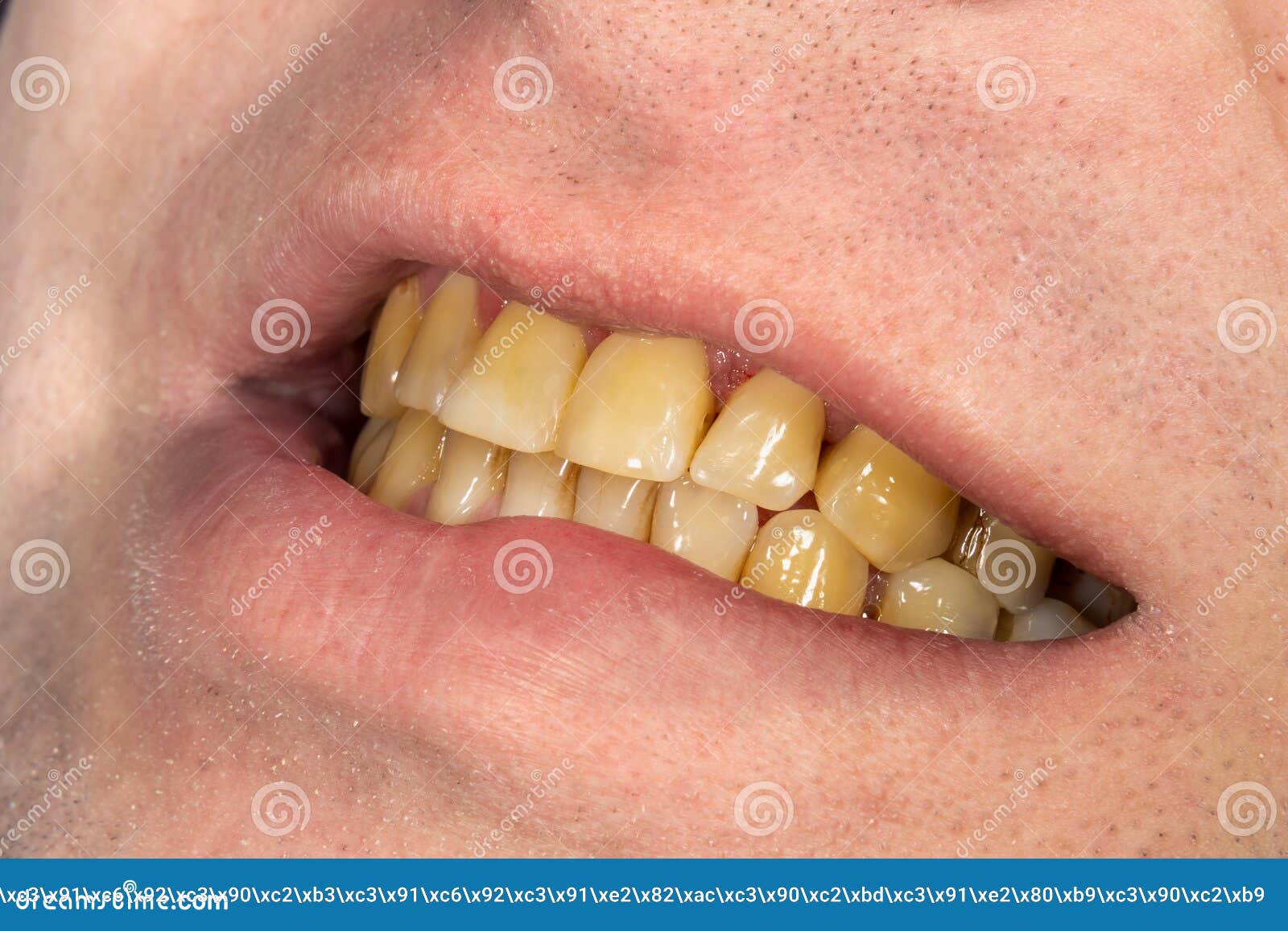 381 Dents De Fumeur Photos Libres De Droits Et Gratuites De Dreamstime 381 Dents De Fumeur Photos Libres De Droits Et Gratuites De Dreamstime