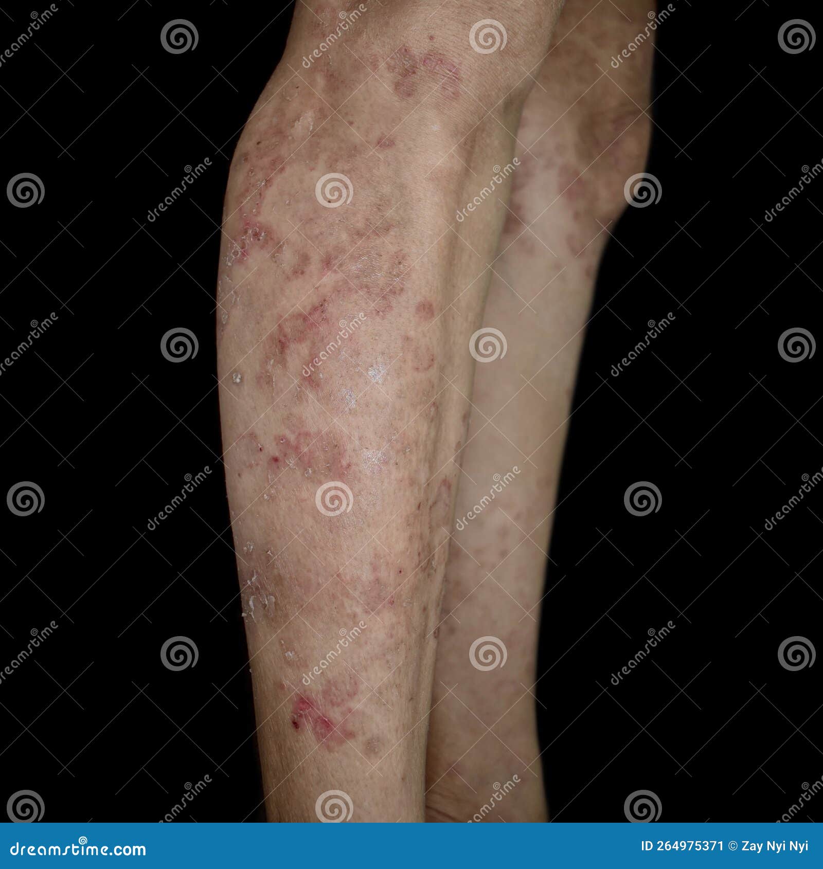 Fungal Infection Called Tinea Corporis Stock Photo - Image of dark,  infection: 260070088