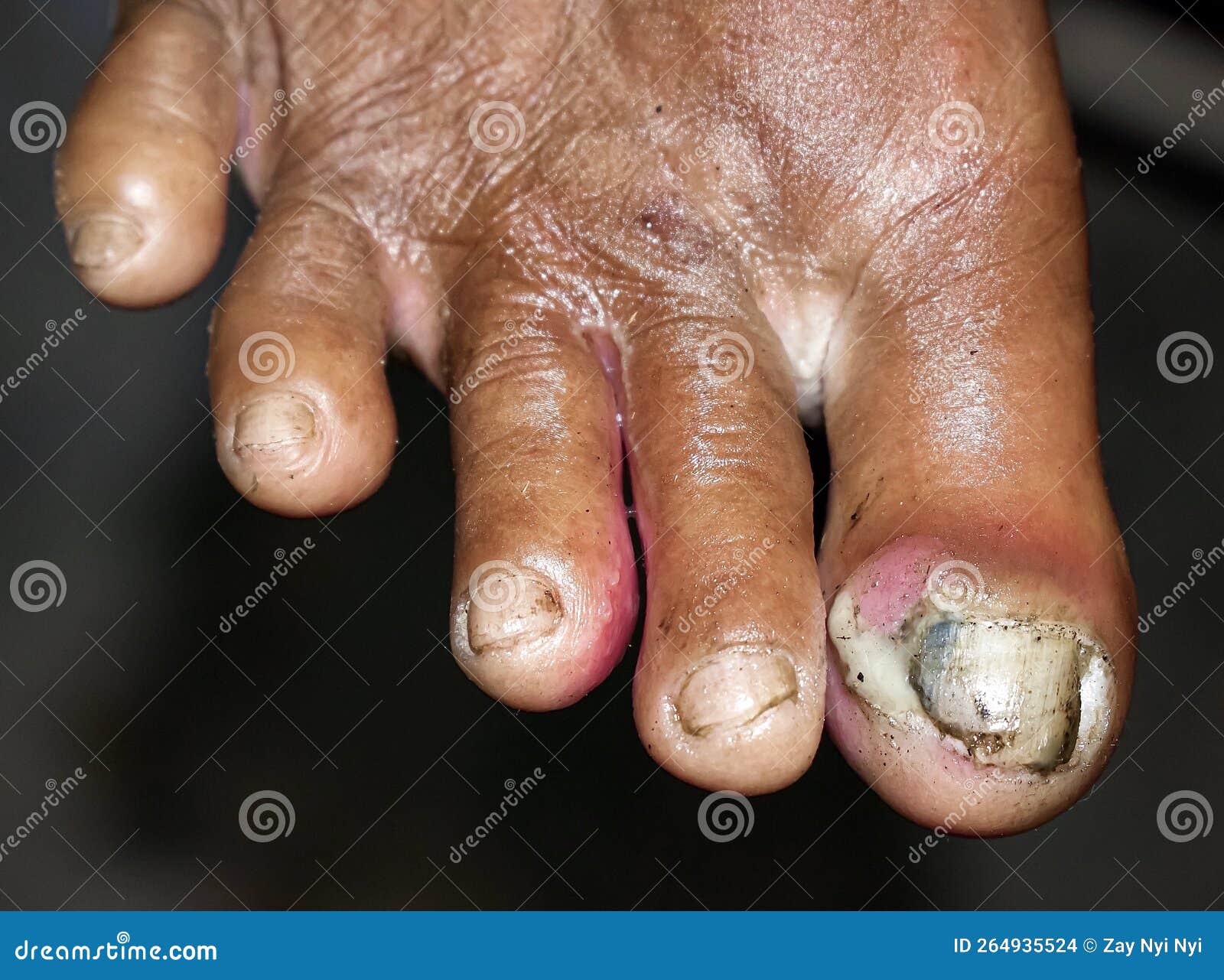 Fungal Infection Called Tinea Pedis and Paronychia at Toes Stock