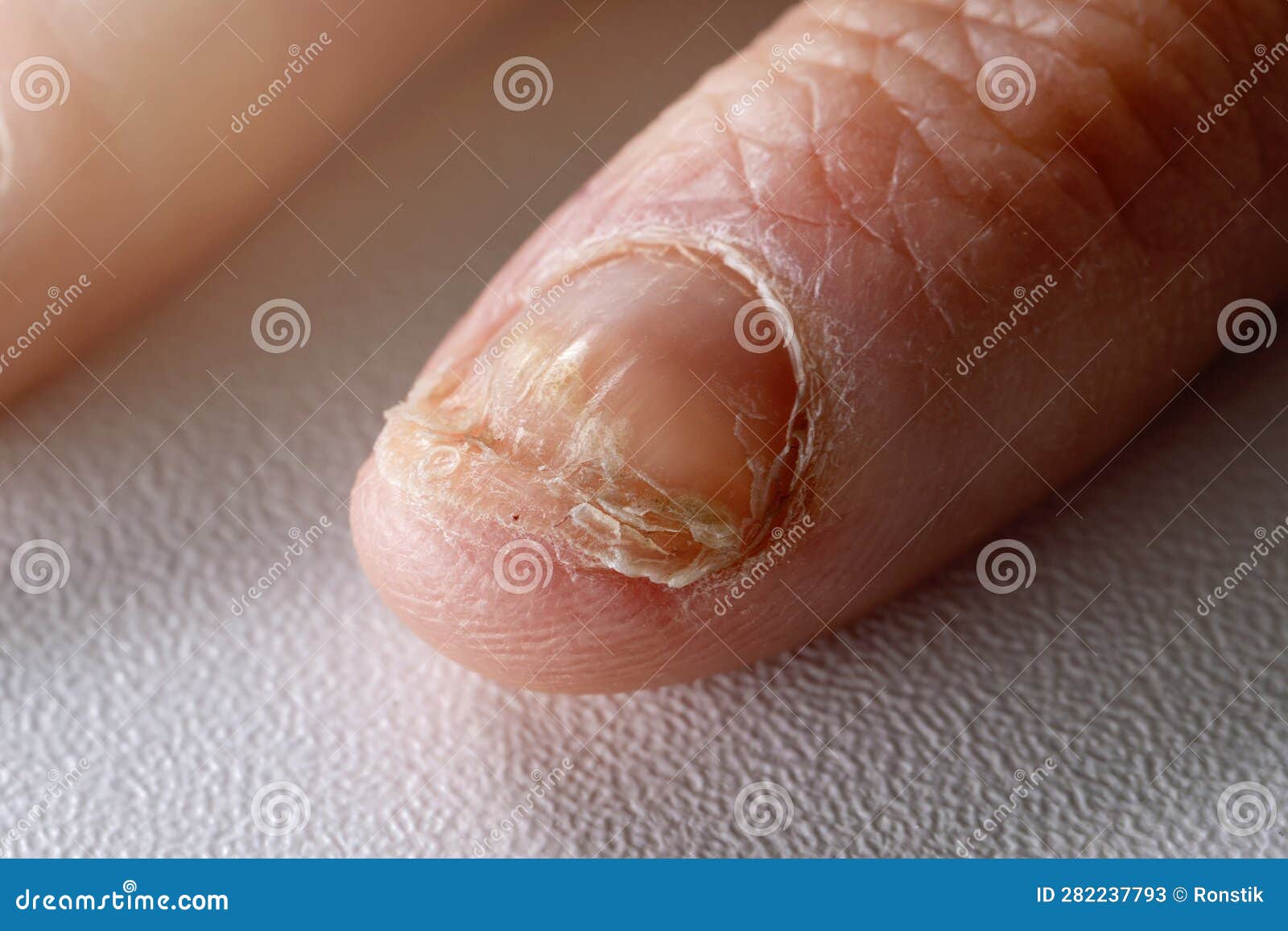 571 Fungal Nails Stock Photos - Free & Royalty-Free Stock Photos from  Dreamstime