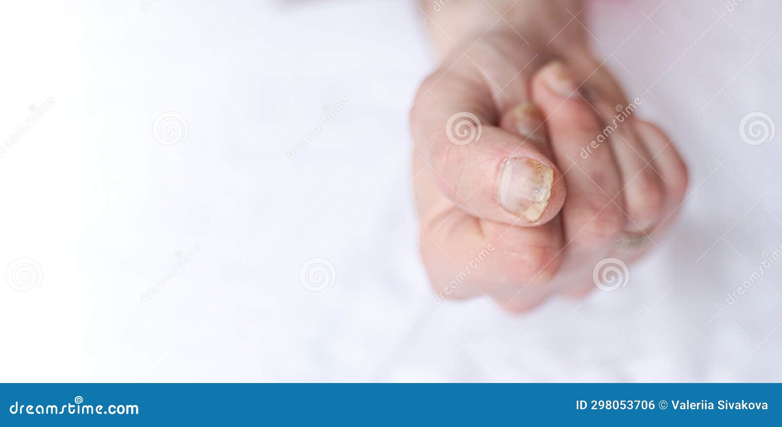 A toddler presents with a dark line on a fingernail | MDedge Pediatrics