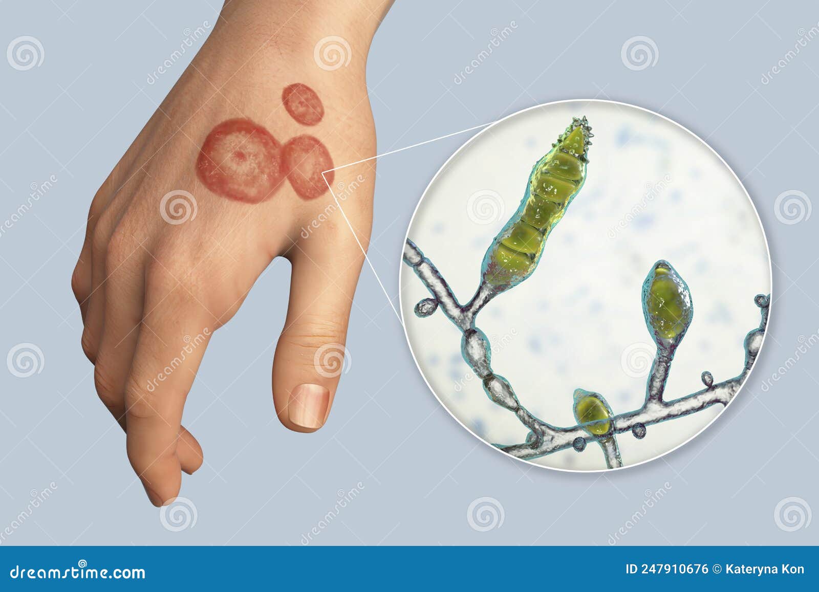 Hand Fungal Infection, Tinea Manuum, 3D Illustration Stock Illustration -  Illustration of dermatophyte, microscopic: 247910676