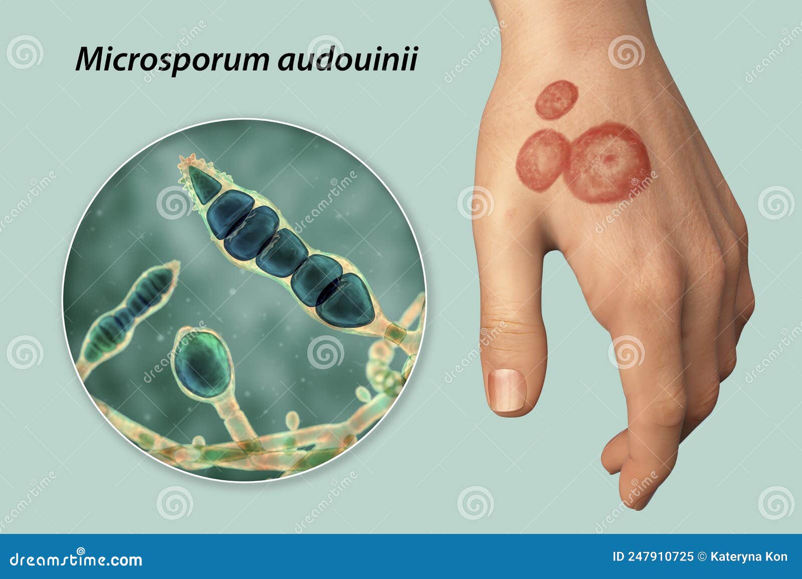 Hand Fungal Infection, Tinea Manuum, 3D Illustration Stock Illustration -  Illustration of human, microscopy: 247910725