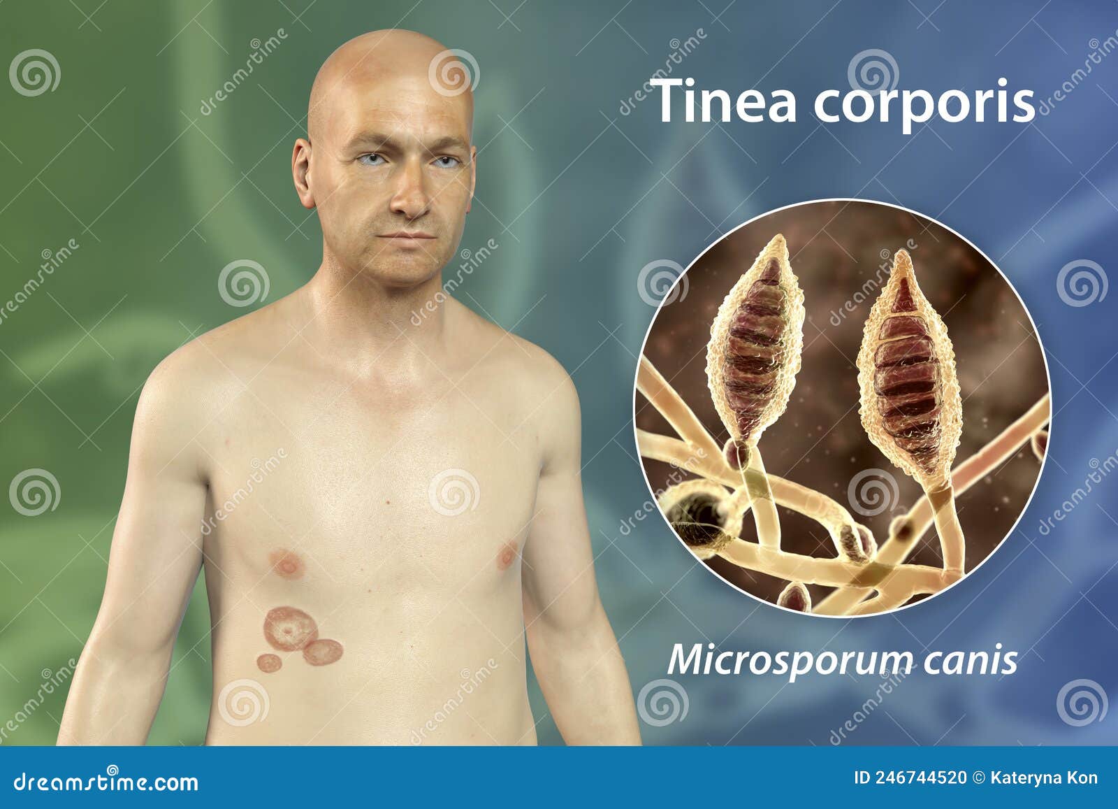 Fungal Infection on a Man S Body. Tinea Corporis, 3D Illustration Stock  Illustration - Illustration of onychomycosis, corporis: 246744520