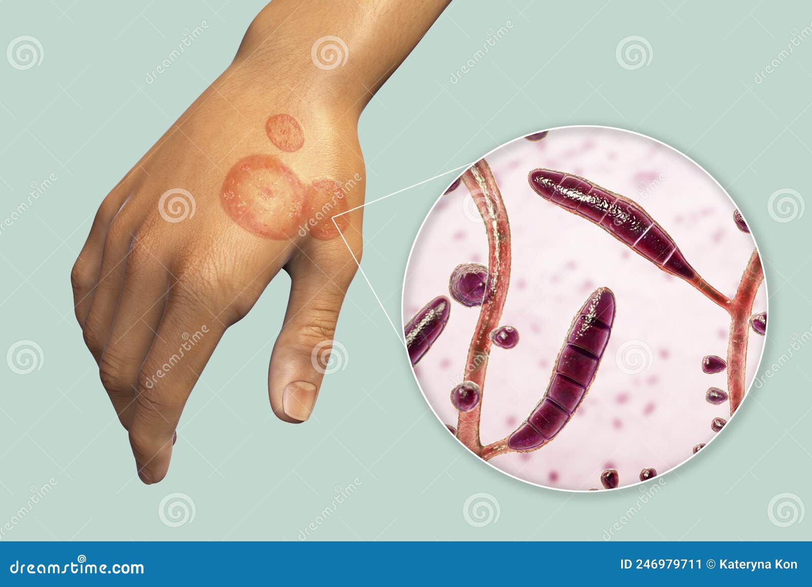 Fungal Infection on a Man S Hand. Tinea Manuum and Close-up View of  Dermatophyte Fungi, 3D Illustration Stock Illustration - Illustration of  tinea, fungi: 246979711