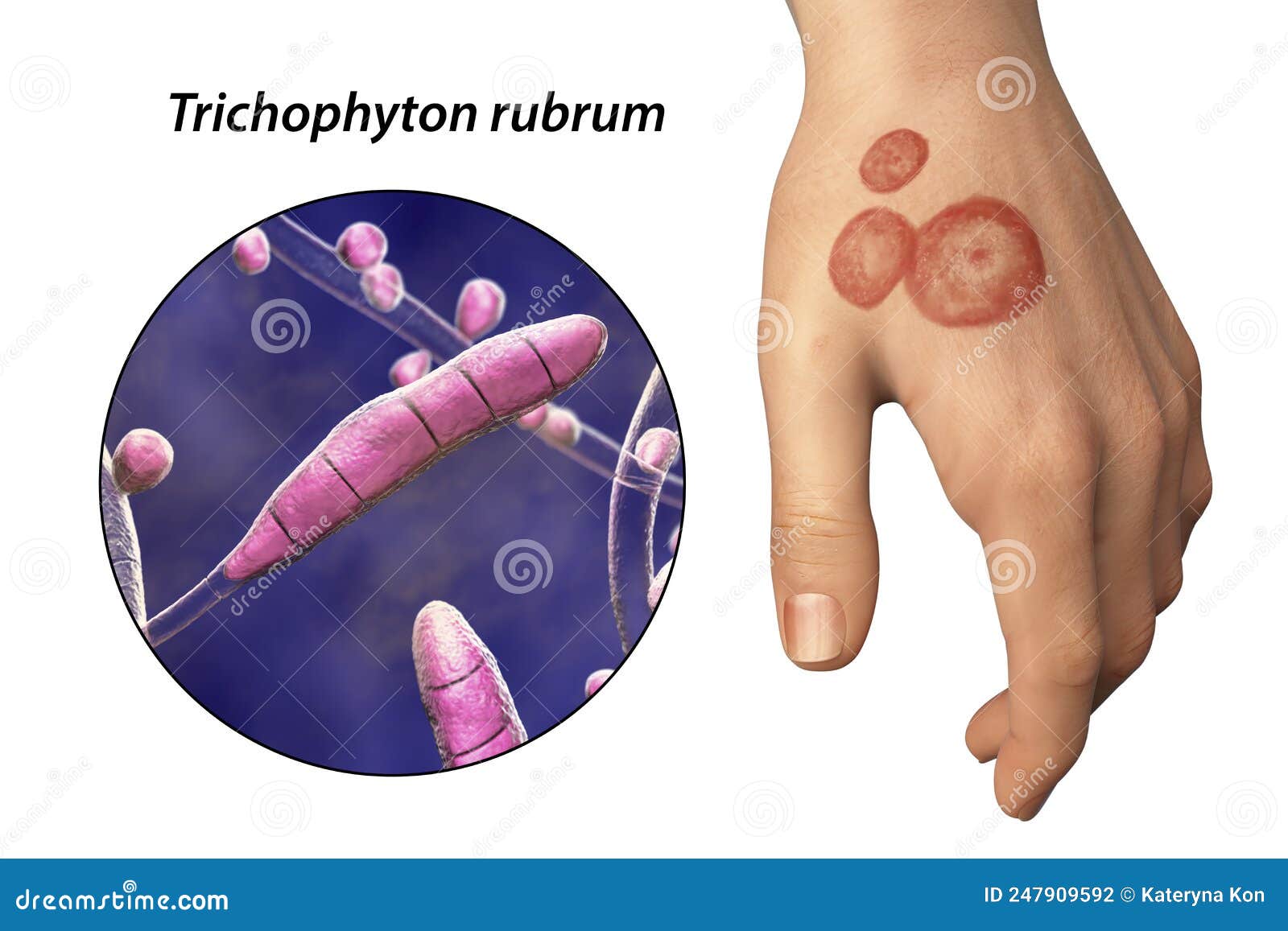 Hand Fungal Infection, Tinea Manuum, 3D Illustration Stock Illustration -  Illustration of hand, microscopy: 247909592