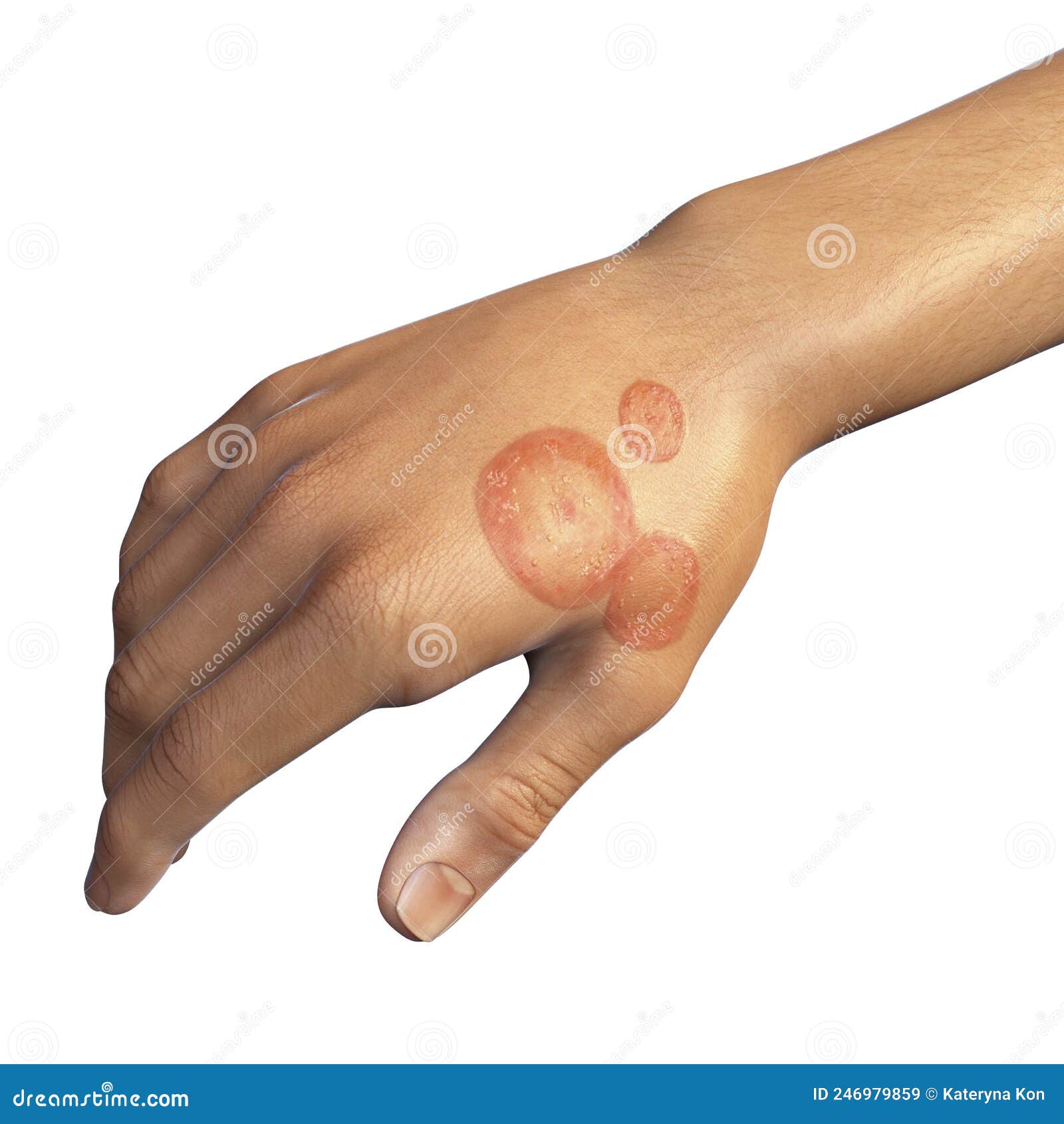 Fungal Infection on a Man S Hand. Tinea Manuum Stock Illustration