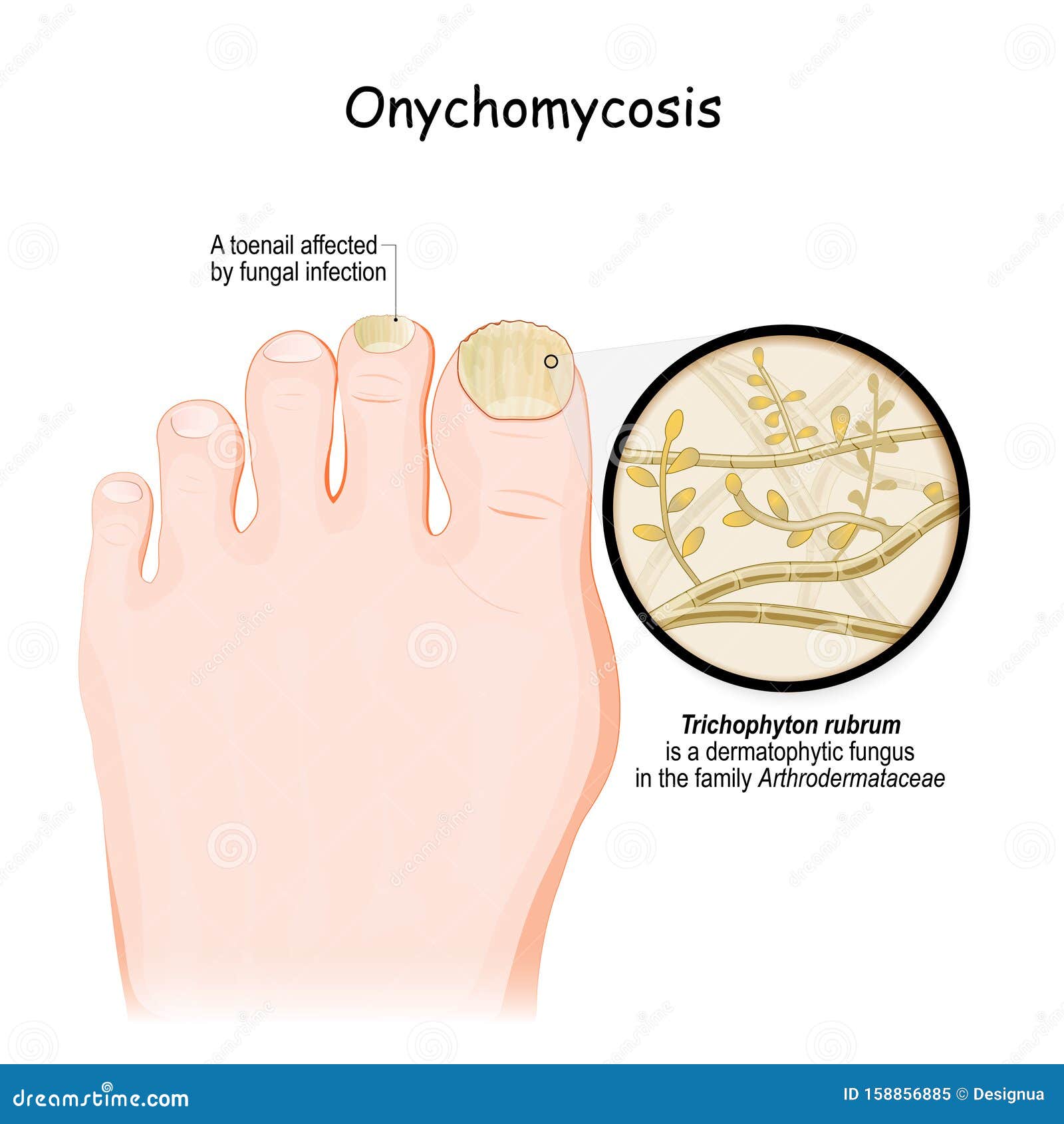 Fungal Infection of the Nail. Close-up of a Toenail Affected by