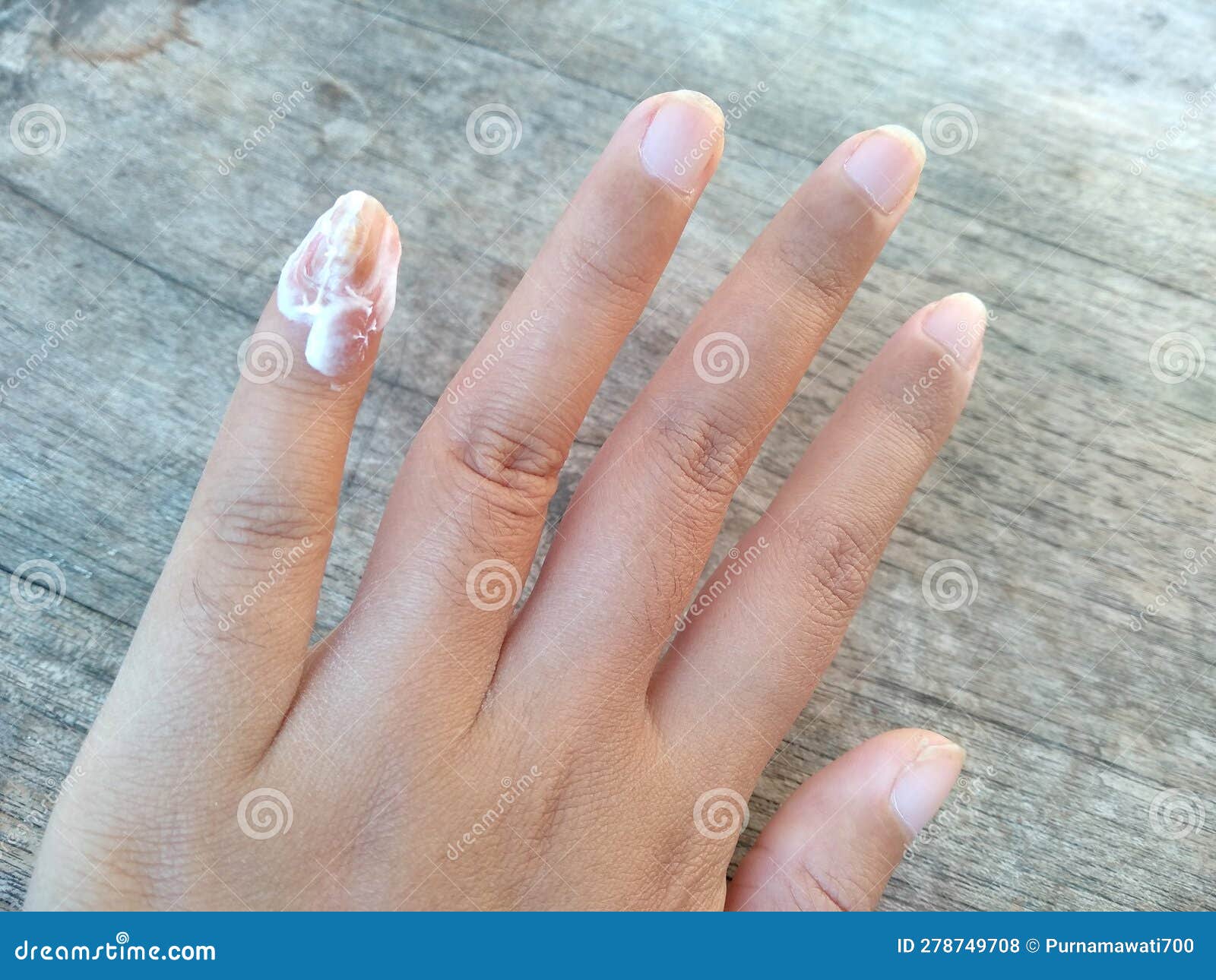 Fingernail Fungus From Acrylic Nails - Prevention, Treatment, Pics & More