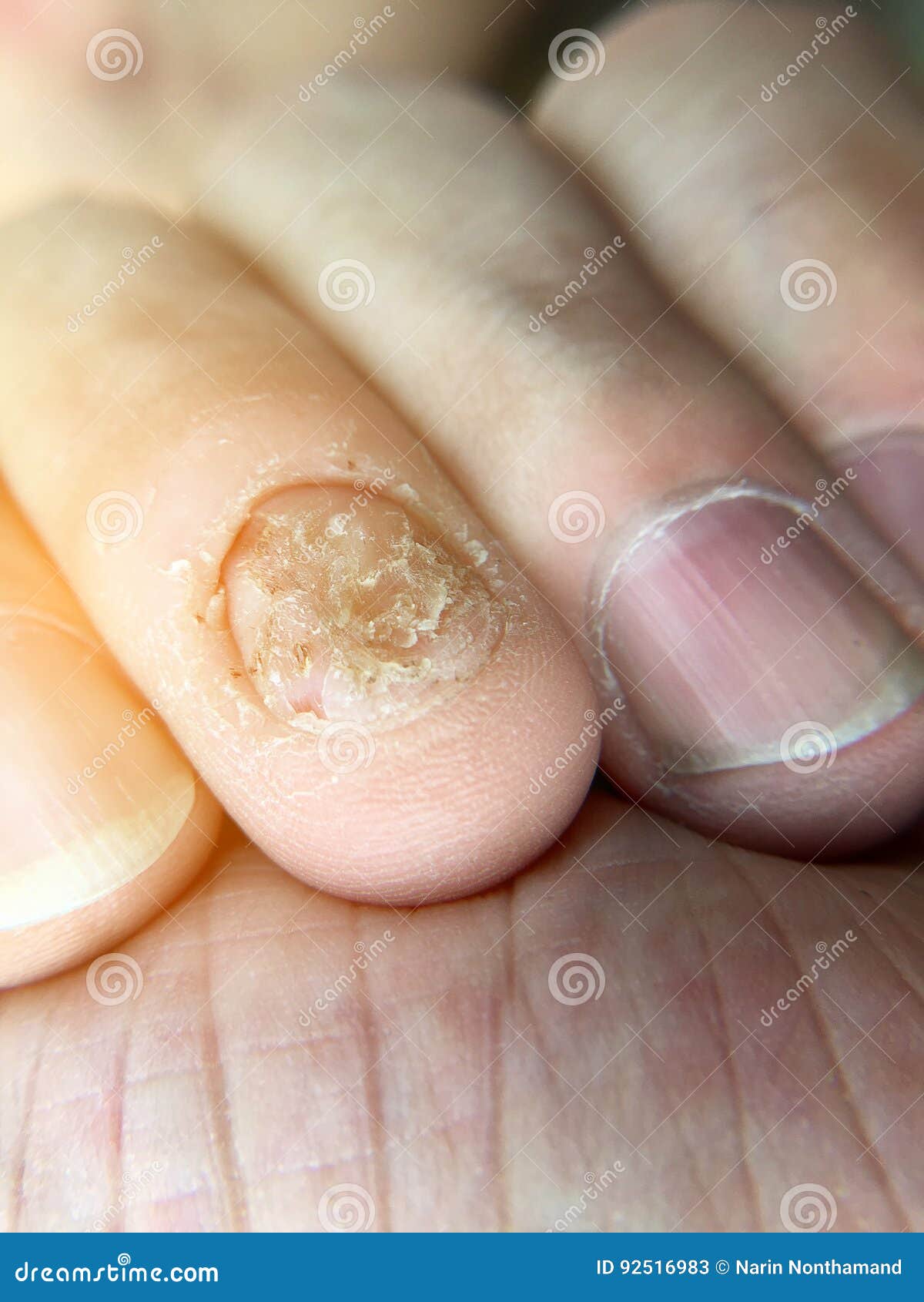 Illustration of a fungal nail infection showing human hand with  onychomycosis and close-up view of Trichopyton mentagrophytes fungi, one of  the causative agents of nail infections Stock Photo - Alamy