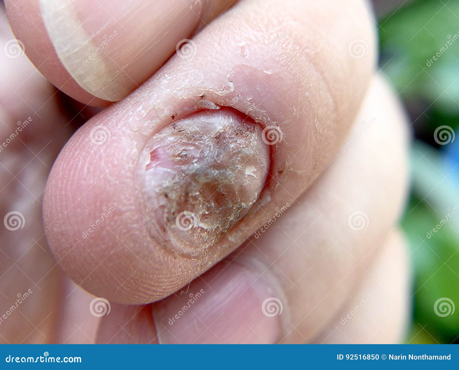 Nail Infections – Dr Aisha Ghias