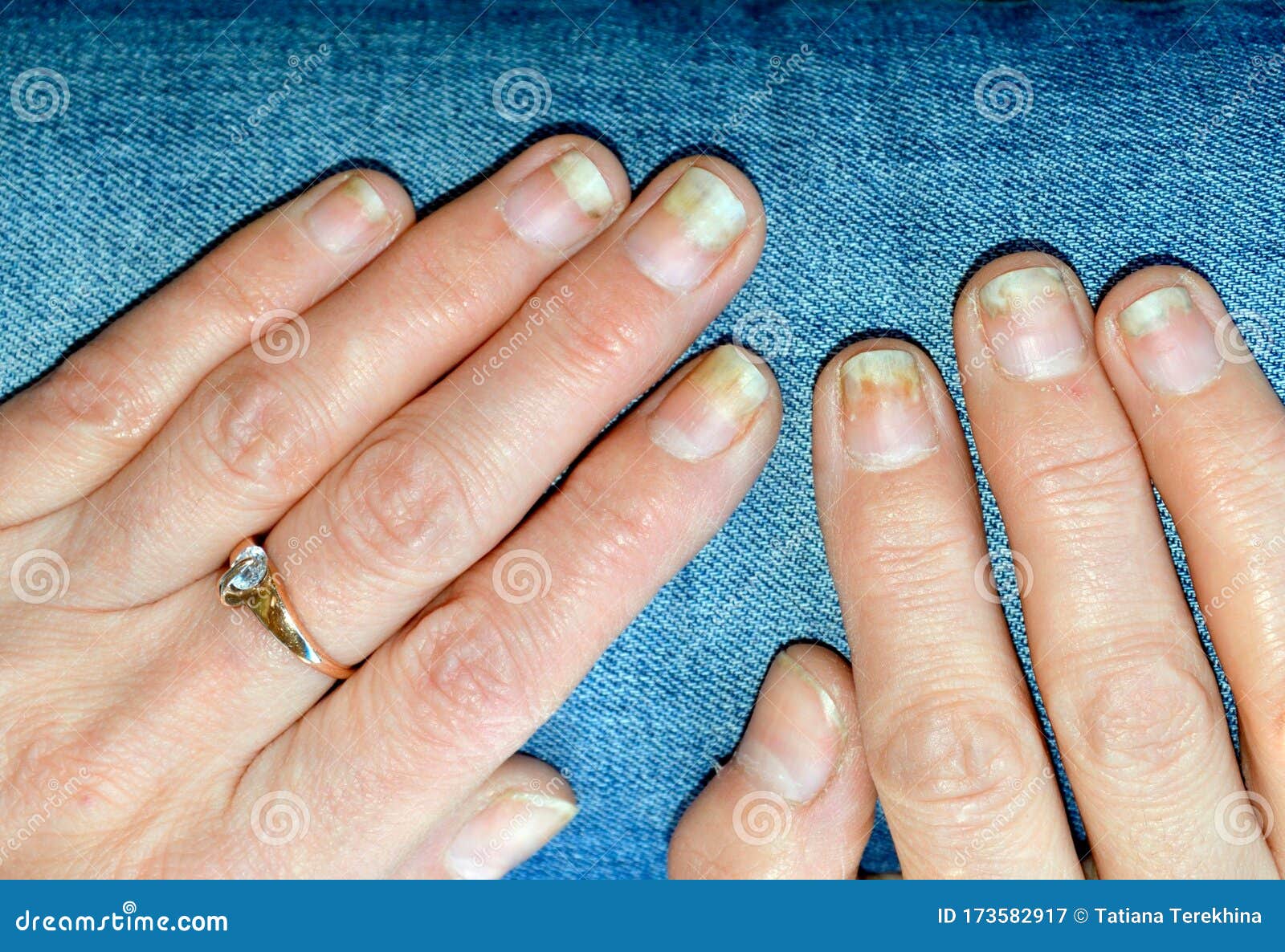 Psoriatic nail dystrophy and polyarthritis showing erythematous... |  Download Scientific Diagram