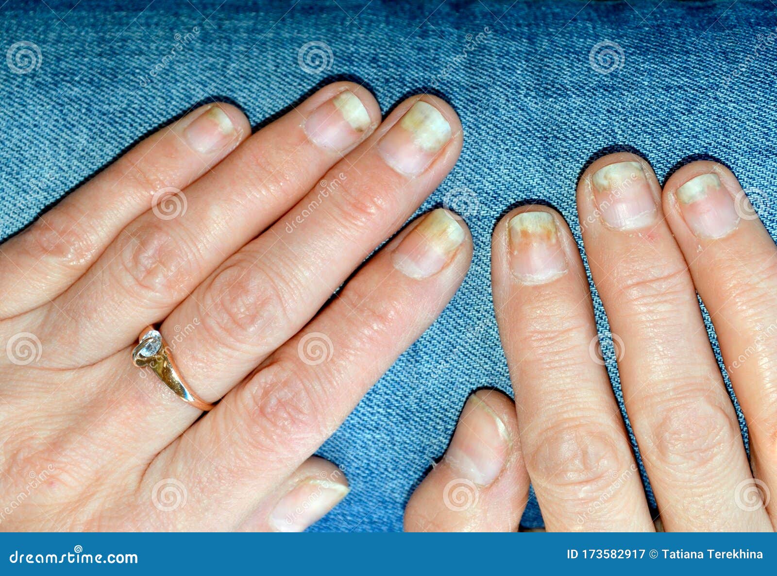 Fungal Nail Infection, Onycholysis after Shellac or Gel-varnish. Stock Image - Image of medical, human: 173582917 Fungal Nail Infection, Onycholysis after Shellac or Gel-varnish. Stock Image - Image of medical, human: 173582917