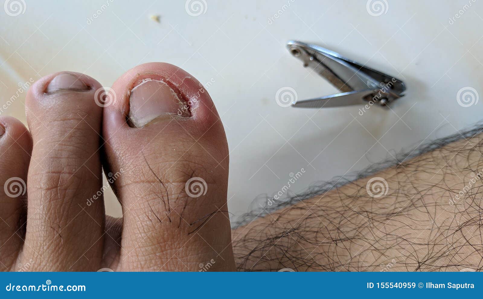 Fungal Nail Infection Paronychia Is An Infection Of The Tissue Adjacent To A Nail Stock Image Image Of Fungus Care