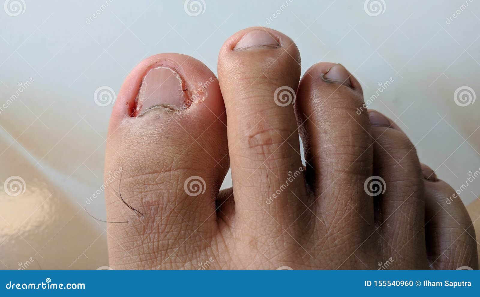 Fungal Nail Infection Paronychia Is An Infection Of The Tissue Adjacent To A Nail Stock Photo Image Of Growth Fungus