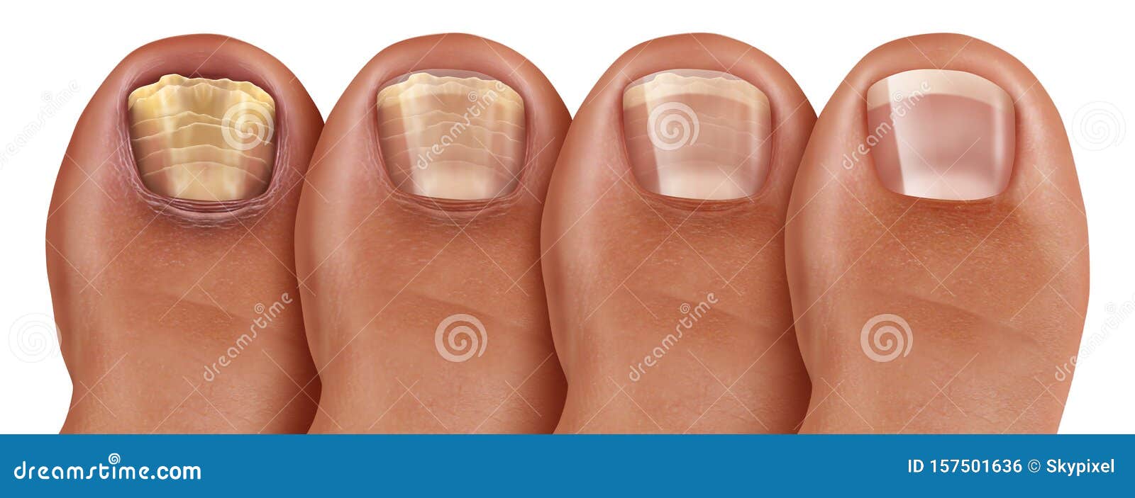 Laser Fungal Nail Treatment Newtown PA | Nail Fungus Bucks County