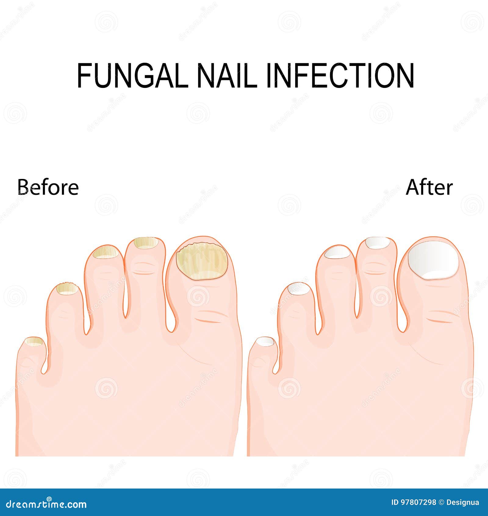 Fungal Nail Infection. before and after Renewal Treatment. Stock