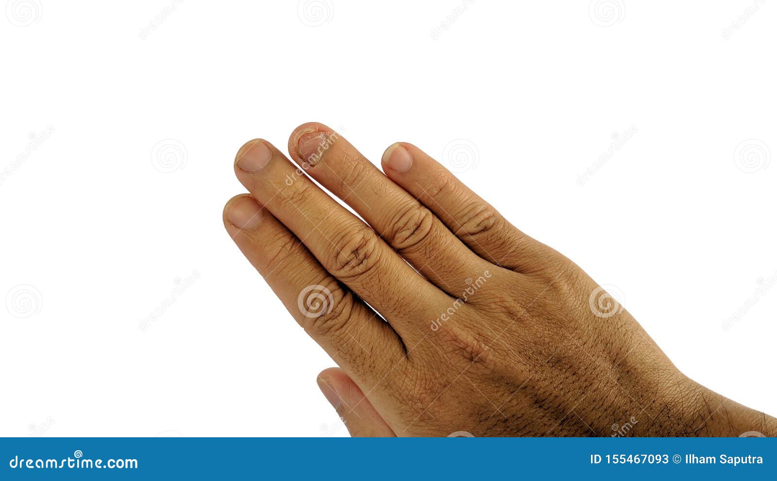 Fungal Nail Infection on Ring Finger, Isolated on White Stock Image ...