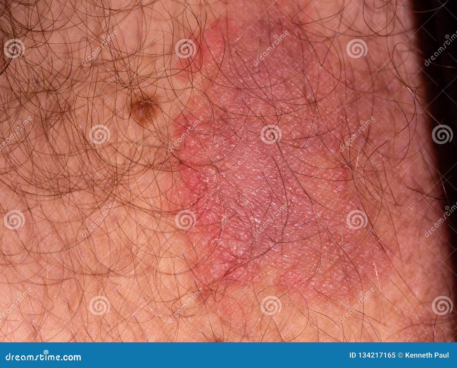 Fungal Rash On Skin