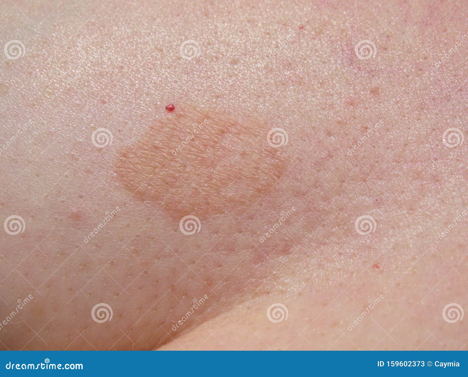 Fungal Skin Rash Infection Mark Close Up Of Patch Stock Image Image