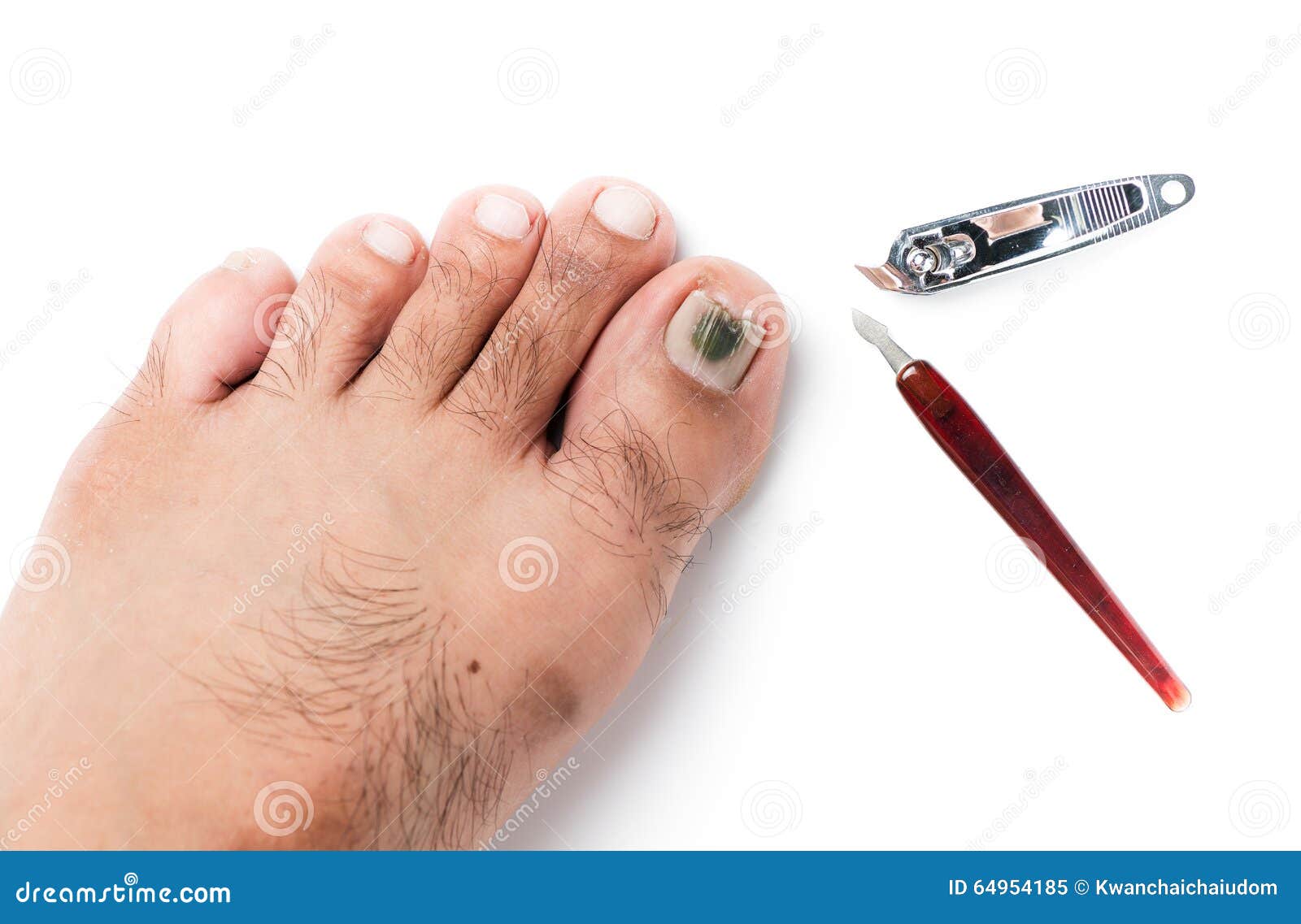 Fungi on Toenail and Nail Clippers Stock Image Image of health