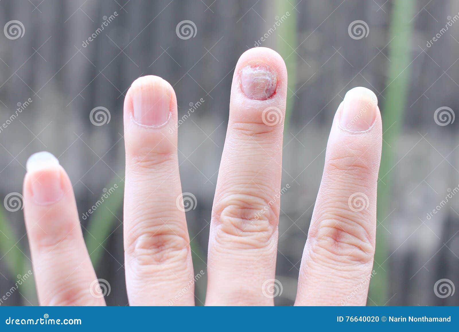 3ml Anti Fungal Treatment Nail Pen Onychomycosis Paronychia Infection  Chinese Herbal Finger Nails Health Care - Nail Treatments - AliExpress