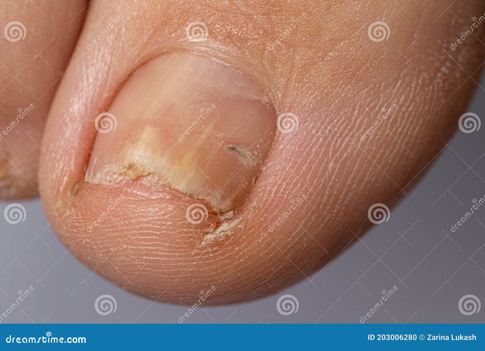 Nail diseases chart: Pictures, symptoms, and treatments