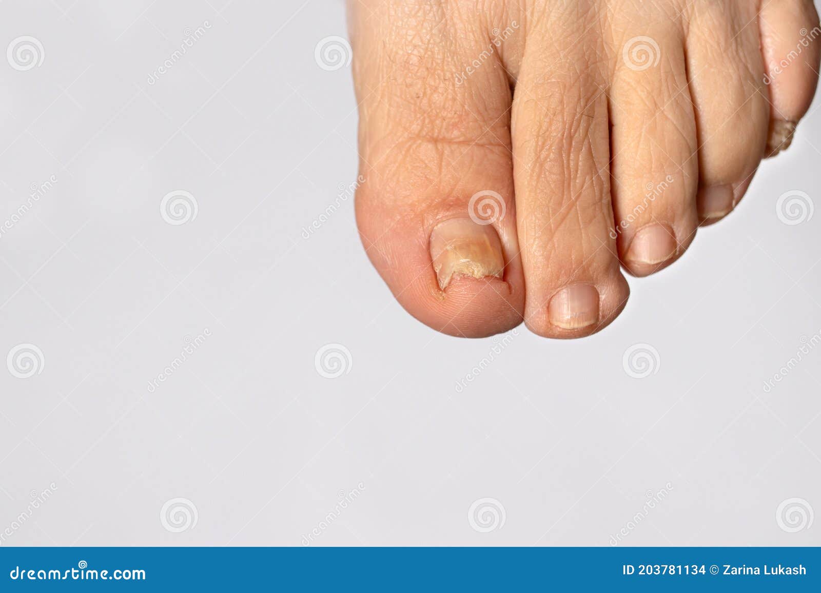 Fungal Nail Infections | Onychomycosis Treatment at The Foot Practice