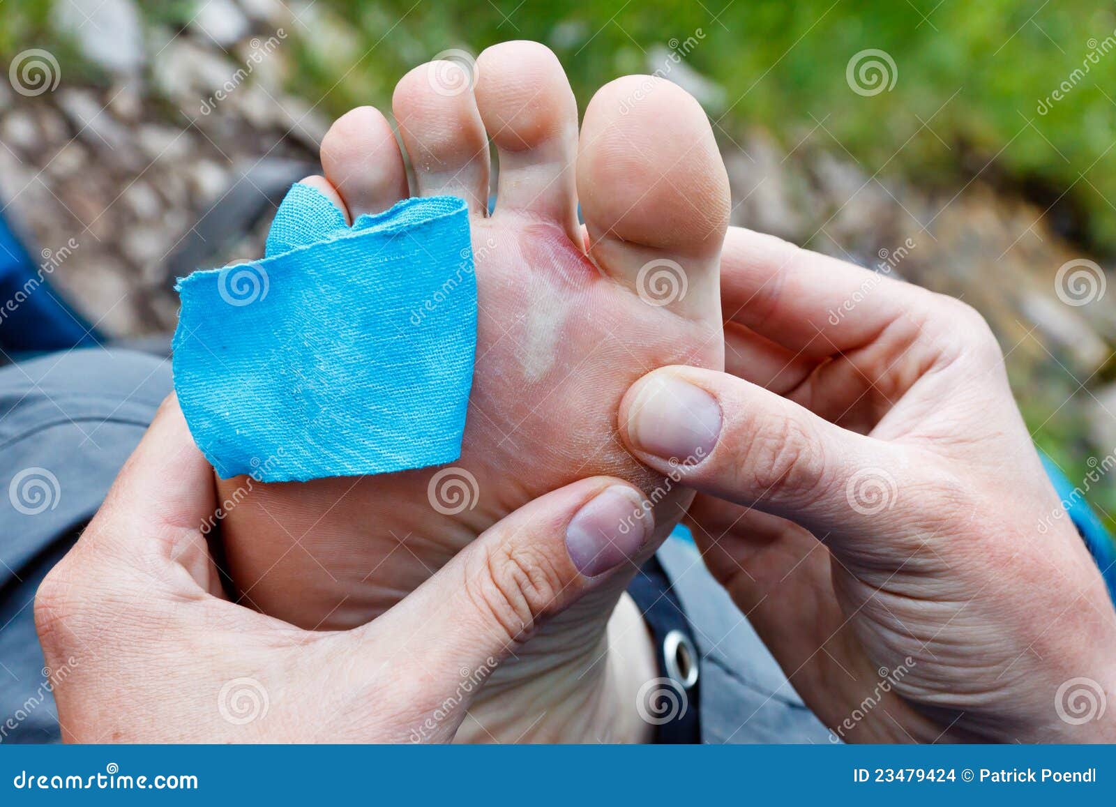 FussBlase stockfoto. Bild von schmerz, wandern, schmerzlich 23479424