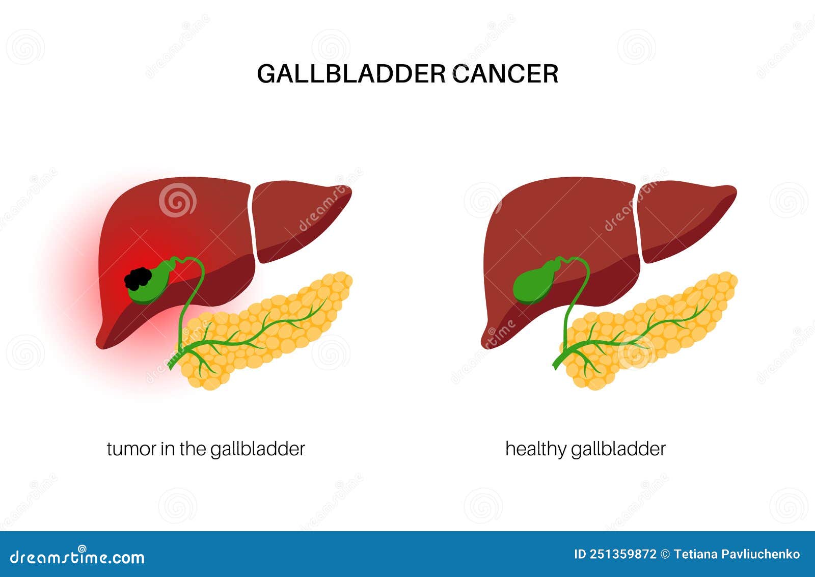 Gallbladder cancer anatomy stock vector. Illustration of digestive ...