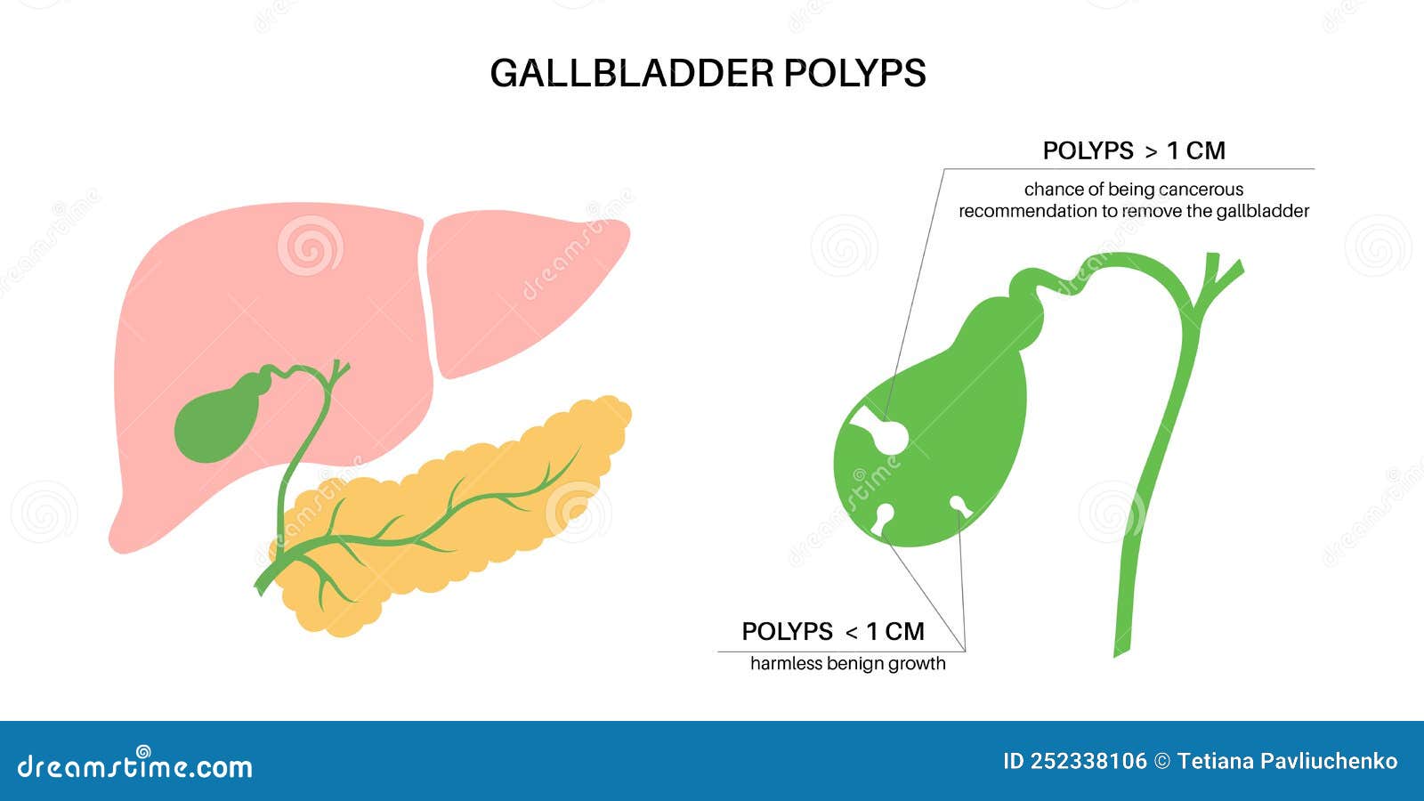 Gallbladder Removal Surgery Cartoon Vector | CartoonDealer.com #252057965