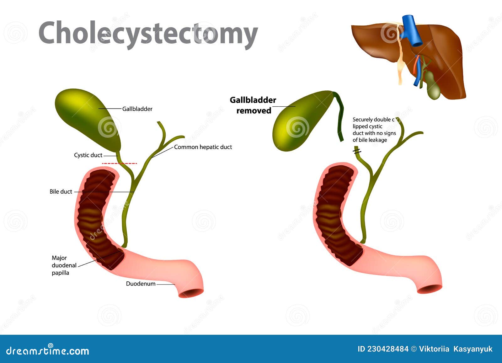 Gallbladder Removal Surgery Cartoon Vector | CartoonDealer.com #252057965