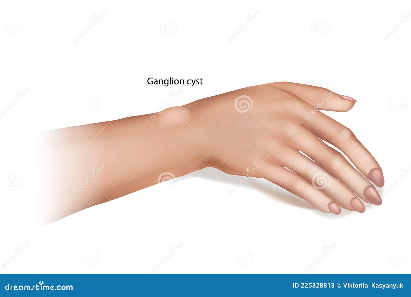 ganglion cyst of the wrist and hand. synovial cyst or a gideon`s disease, or a bible cyst, or a bible bump