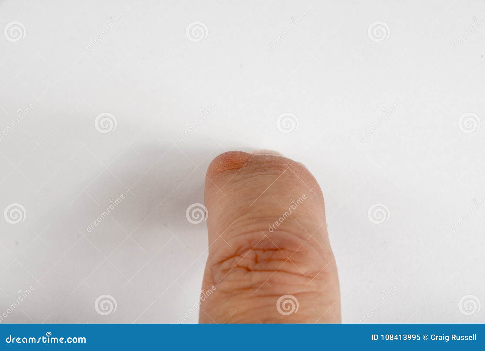 warm compress for cyst on finger warm compress for cyst on finger