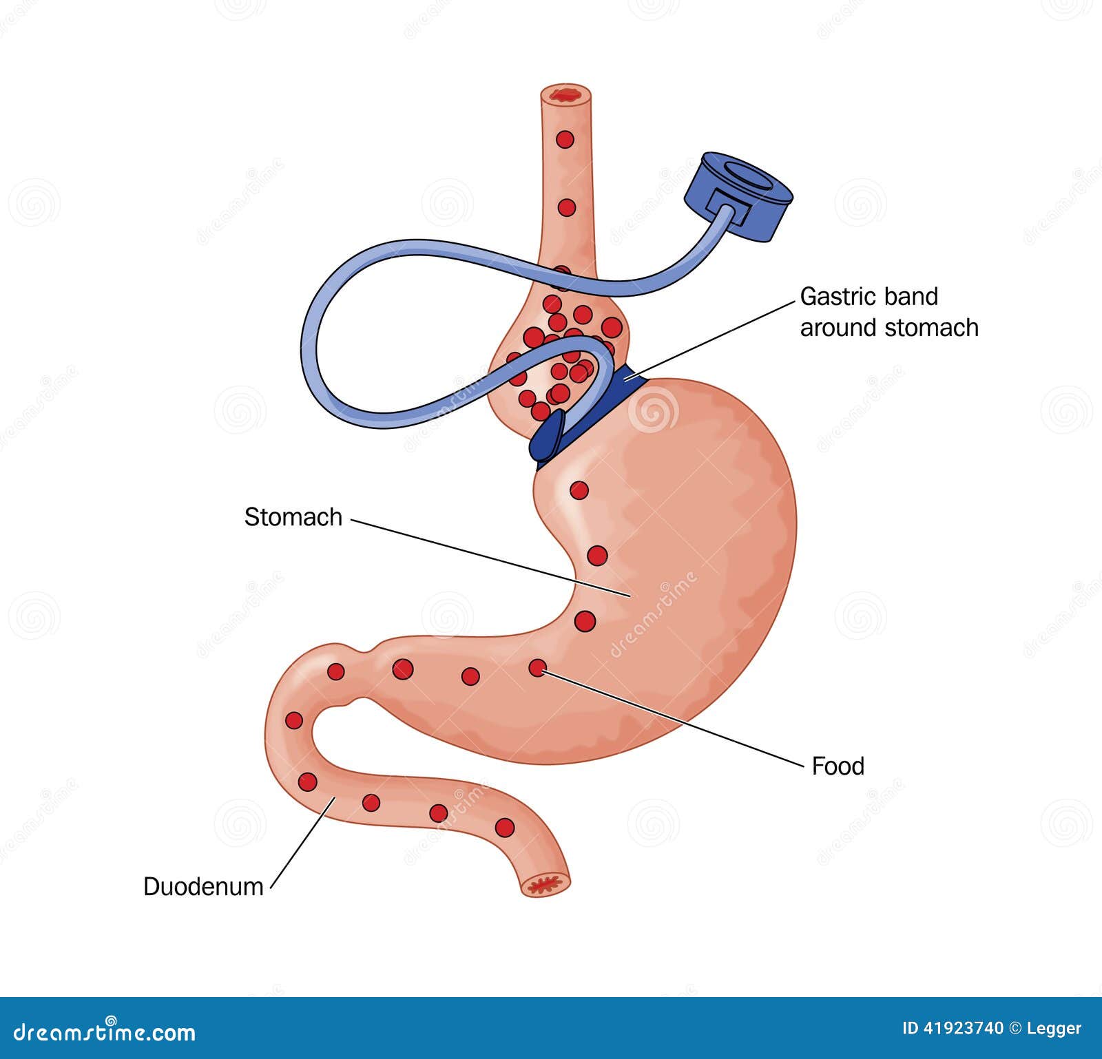 Lap Band Surgery, Adjustable Gastric Band - BeLiteWeight