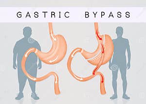 Gastric Bypass And Gastric Band Stock Image CartoonDealer 82452793
